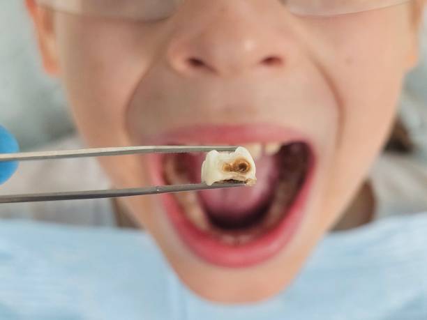Best Emergency Wisdom Teeth Removal in Loomis, CA